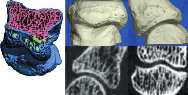 a Trabecular bone Cortical bone Cortical breaks >0.5 mm b d Figure 4 HR pqct imaging of anatomical sites prone to develop bone erosions.