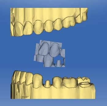 7 Edit orders Sirona Dental Systems GmbH 7.4 MODEL phase Registration Registering the buccal acquisition on the lower jaw and upper jaw 1.