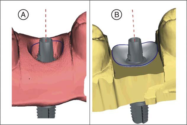 Sirona Dental Systems GmbH 8 Design examples 8.3 Abutment - framework 8.3.6 Mask areas Instructions The step "Trim Area" is active.