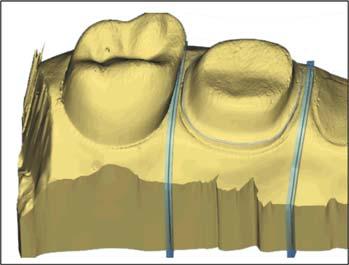 Sirona Dental Systems GmbH 8 Design examples 8.6 Model Segmenting the model The step "Segmentation" is active. 1.