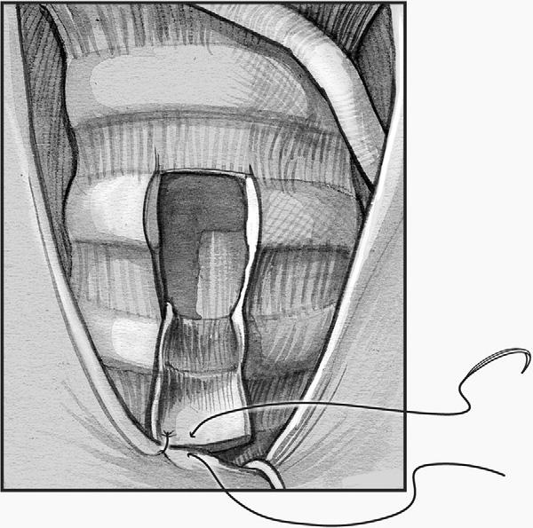 This Bjork flap can be reflected anteriorly and sewn to the inferior aspect of tracheotomy wound thus creating a more long term stoma (Figure 6).