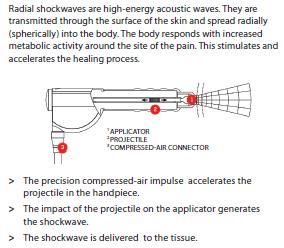 What is Extracorporeal Shock Wave Therapy? (ESWT) Extracorporeal Radial shockwaves are high-energy acoustic waves.