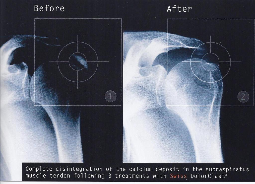 Calcification of Rotator Cuff 12 weeks after treatment scan