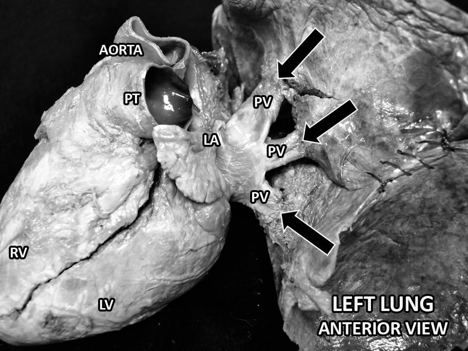 283 284 285 286 287 288 289 290 291 292 293 294 Figure 3: (A) Case 3--Anterior view of the left lung and heart of a 70-year old male.
