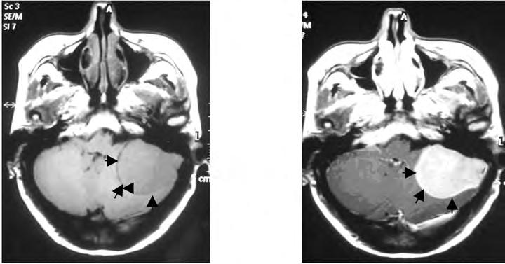 A B FIGURE 1: (A) A T1-weighted magnetic resonance imaging (MRI) scan demonstrating an isointense mass with sharp edges (arrows) in the region of the posterior petrous.