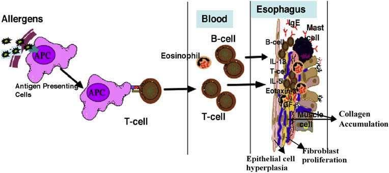 Figure 1. This figure shows the pathogenesis of EoE. First allergens are engulfed by antigen presenting cells (APC s) near the esophageal lumen or skin.