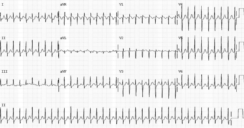 52 Tachycardia complexes (in absence of previous conduction defects), sudden onset and termination and ventricular rates between 150-250 beats/min (Fig 6)