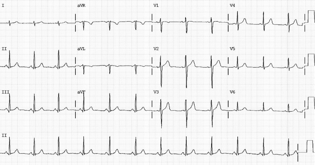 42 Tachycardia branch and central branch and the right bundle branch, which traverses along the right side of the interventricular septum. 1.