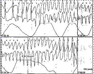 60 Tachycardia Fig. 8. Torsades de pointes In patients with Tdp, the reversible cause should be corrected such as discontinuing Class IA or III antiarrhythmic, or QT prolonging drug.