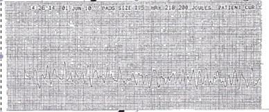 62 Tachycardia disease. Therapy is similar to other types of VT. Pace termination is effective in acute setting and radiofrequency ablation is effective in elimination of VT. 15.