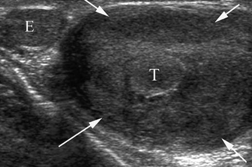 Extratesticular Masses in hildren Pediatric Imaging Pictorial Essay Downloaded from www.ajronline.org by 37.44.201.88 on 11/19/17 from IP address 37.44.201.88. opyright RRS.