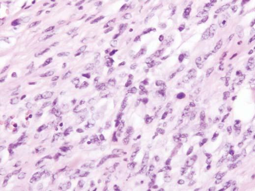 , Photomicrograph of histopathologic specimen shows highly cellular neoplasm composed of abundant small, round blue cells arranged with lack of cohesive pattern.