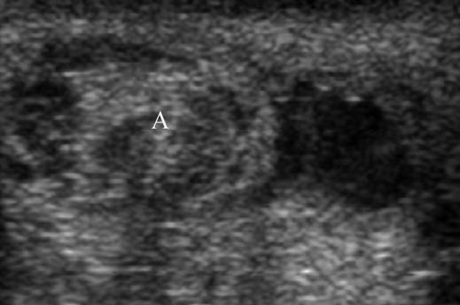 Torsion of these appendages causes acute scrotal pain and a focal bluish discoloration beneath the skin (so-called blue-dot sign). tender nodule is commonly palpated on physical examination Fig.