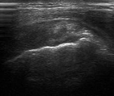 Introduction to Ultrasound Examination of the Hand and upper Emil Dionysian, M.D. Ultrasound of upper ext.