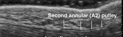of a normal variant accessory muscle that may be associated with compression of the adjacent ulnar nerve. Figure 24.