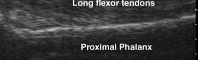 flexor sheath that extends to the sides of the base of the proximal phalanx. Figure 25.