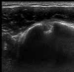 Ultrasound in Upper