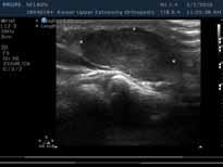 Hand and wrist UTS evaluation Mass in the palm Mass Ligaments Tendon: Location