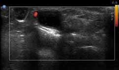 Transverse sonogram through the anatomic snuffbox shows the tendons of the first extensor compartment: the extensor pollicis brevis (EPB) and the abductor pollicis longus (APL).