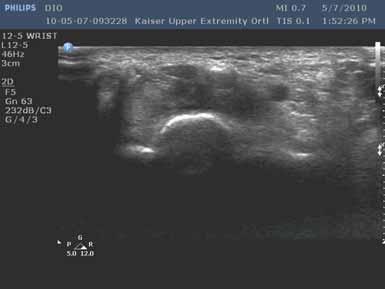 Normal sonographic appearance of nerves.