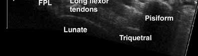 the flexor carpi radialis (FCR) tendon within the lateral part