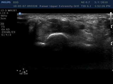 Sonographic appearance of the long flexor tendons in the palm.