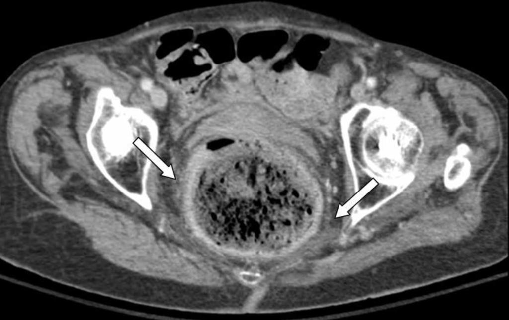 Fig.: 85-year-old bed-ridden woman with history of constipation and abdominal pain.