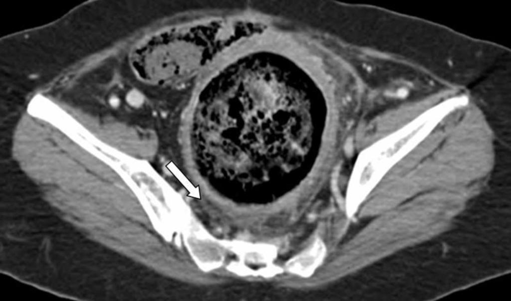 Fig.: 37-year-old woman who takes narcotics for metastatic breast cancer and has a history of constipation and abdominal pain.