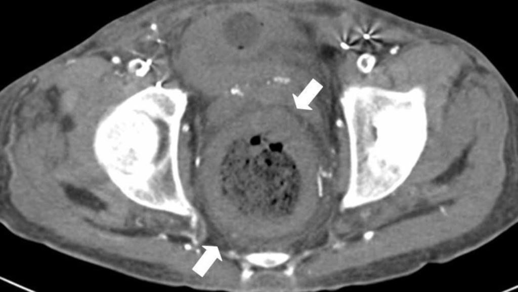Fig.: 43-year-old diabetic man with abdominal pain.