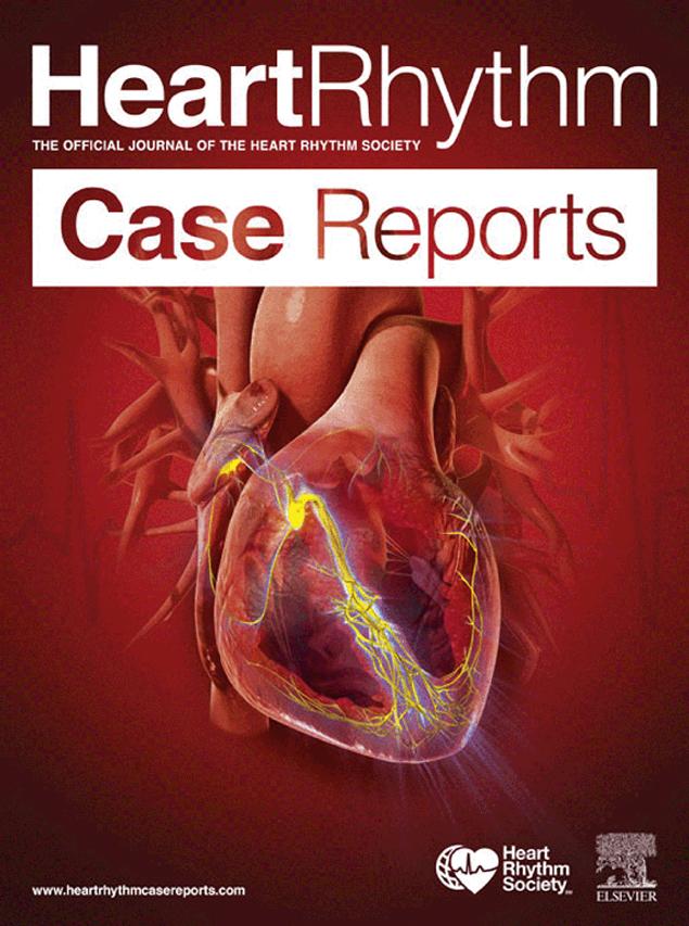 Accepted Manuscript A rare case of acute myocardial infarction during extraction of a septally placed implantable cardioverter-defibrillator lead Eric Wierda, MD, LLM, Astrid A.