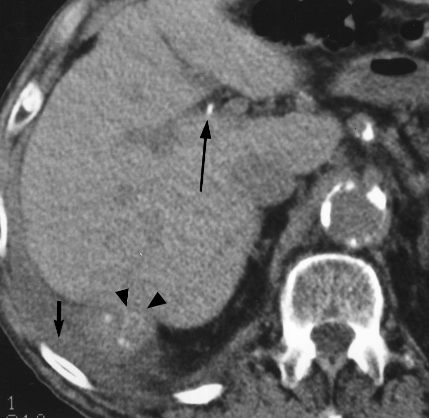 These cases were found during a retrospective review of laparoscopic cholecystectomies performed at eth Israel Deaconess Medical Center and the affiliated hospitals since 1990, and include one