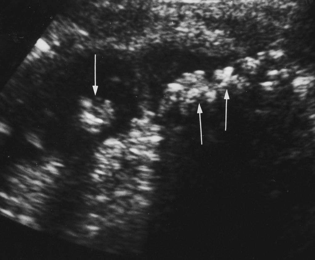 abdominal pain and fever, which revealed a pleural effusion, a subphrenic and perihepatic collection, and a thickened diaphragm that clearly contained two calculi smaller than 1 cm in diameter seen