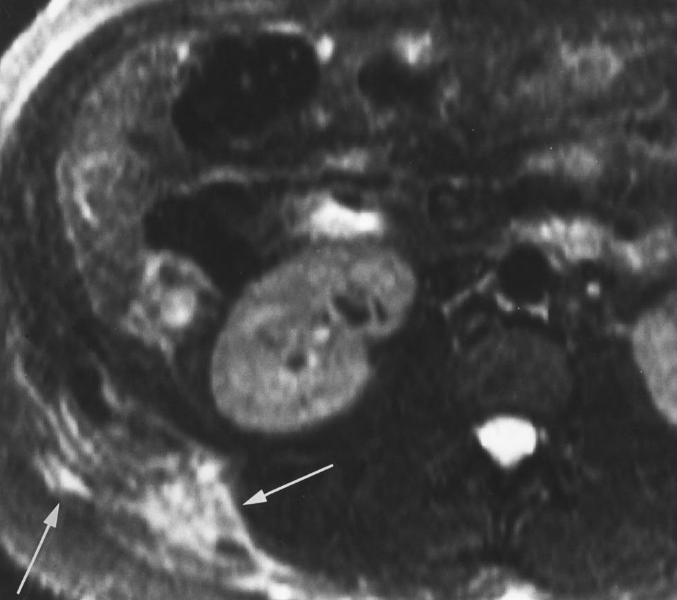 Morrin et al. Fig. 3. 85-year-old woman who presented 4 years after laparoscopic cholecystectomy with painful right-flank mass.