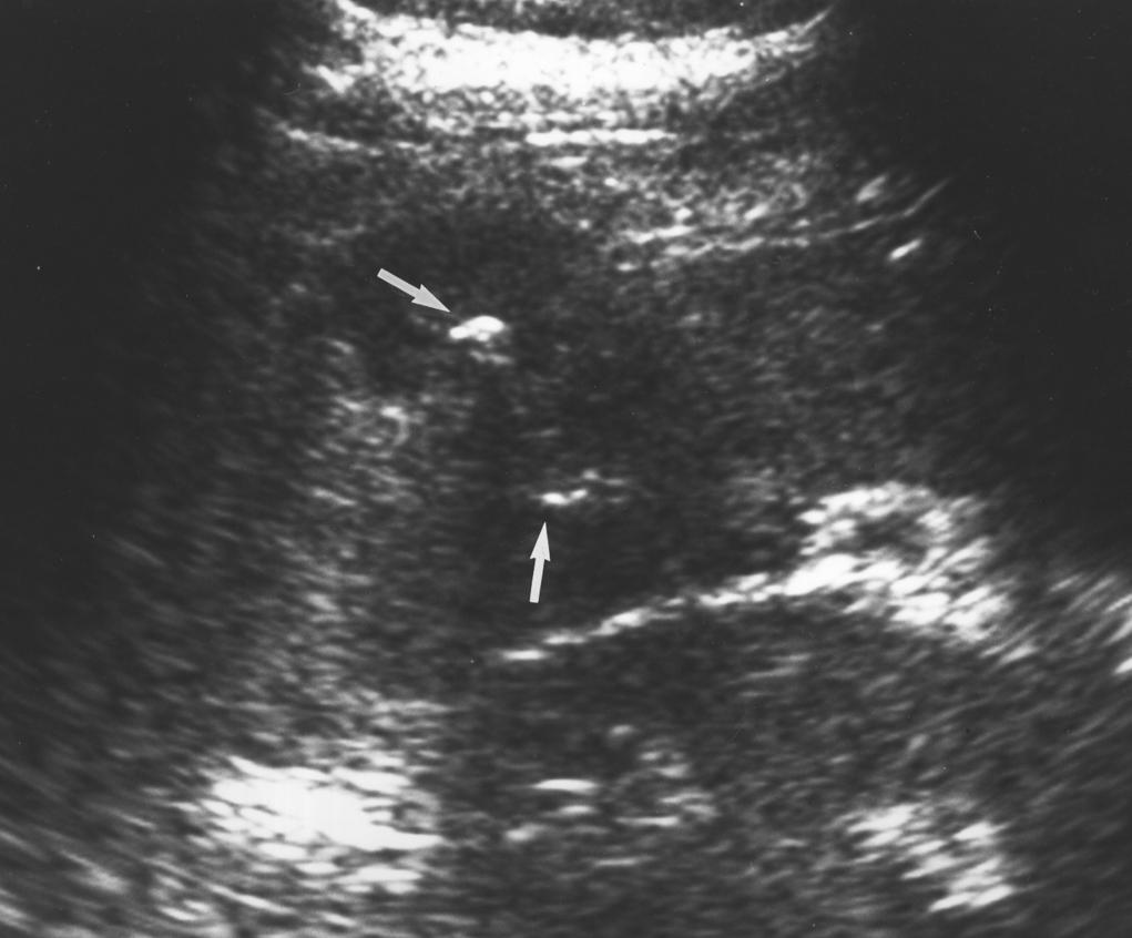 50-year-old woman who presented 2 years after laparoscopic cholecystectomy with persistent painless right-flank swelling, which she initially attributed to trauma