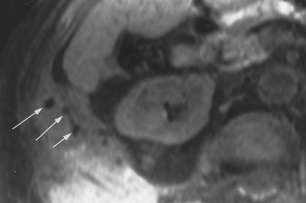 In addition, large heterogeneous collection within abdominal wall was seen (not shown).