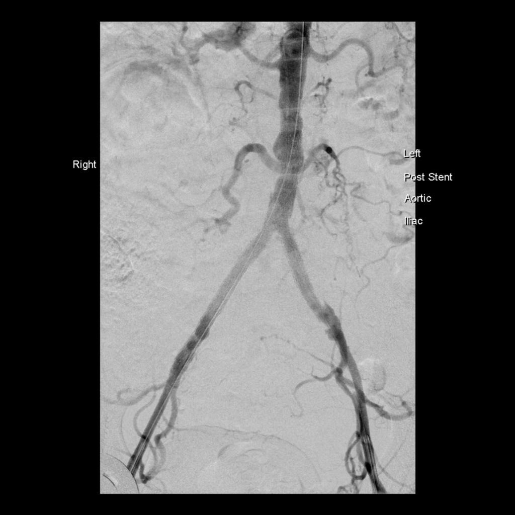 Fig. 6: Completion angiogram after stenting of the right CIA and EIA