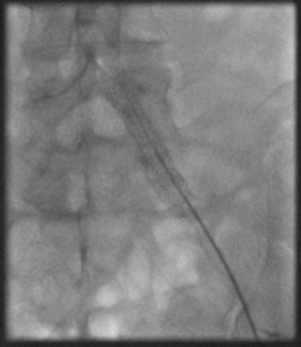 Fig. 10: DSA shows occluded left CIA stent Fig.