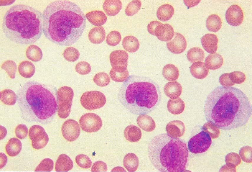 Monocytic leukemia AML M5b <80%