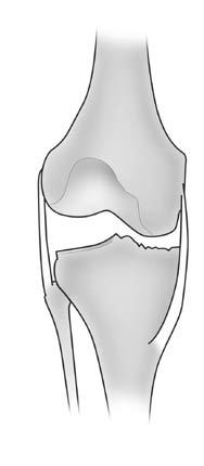 Although the joint line often changes as a result of a posterior cruciate substituting procedure, it is important that an attempt be made to maintain the joint line when high flexion is a priority.