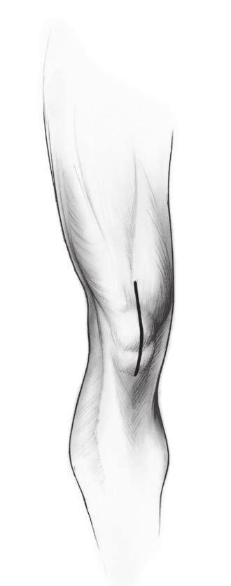 An elevated joint, for example, can cause tibiofemoral tightness in roll-back and thus restrict flexion.