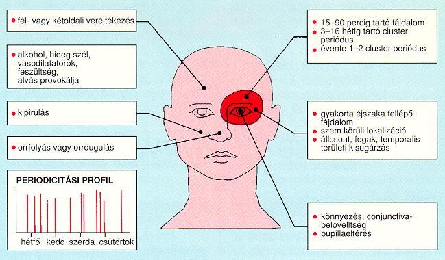 CLUSTER HEADACHE ACCOMPANYING SIGNS UNILATERAL SWEATING ALCOHOL, COLD WIND, VASODILATORS, ANXIETY, BUT ALSO SLEEP PROVOKE DURATION OF AN ATTACK: 15-180 MINUTES; DURATION OF A CLUSTER PERIOD: 3-16