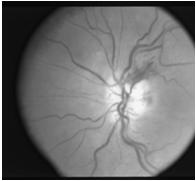 Circulation Ischemic Optic Neuropathy