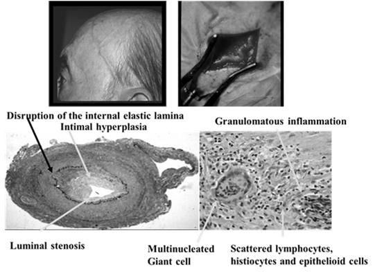 Cranial Arteritis Retinal Artery Occlusion Carotid stenosis, cardiogenic emboli,