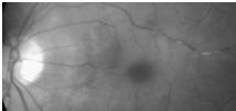 retina/brain (Susacs) Multiple sclerosis Asymptomatic BRAO BRAO Birdshot