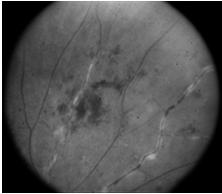 Wegeners, Polyarteritis Toxoplasmosis Optic disc vasculitis Acute retinal necrosis