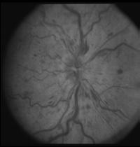 myeloproliferative disorders, anemia Transient Visual Obscurations Optic disc edema
