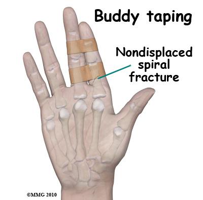 see that the finger is deformed. It is common to see a bump over the back of the finger where the fracture is located and angulated (or bent).