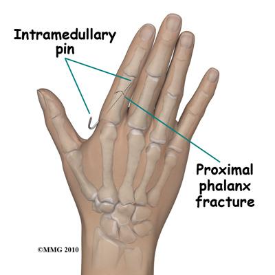 fingers. Surgery A finger fracture may require surgery.