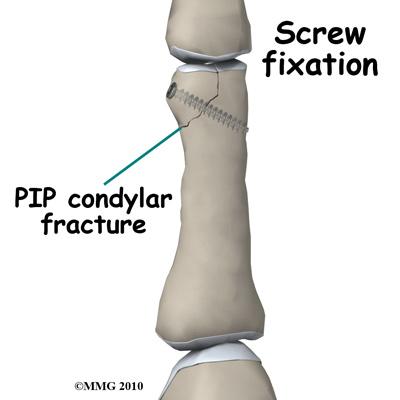 If the fracture cannot be held in acceptable position with a splint and the fragments begin to separate, surgery may be suggested after several days or weeks of attempting non-surgical treatment.