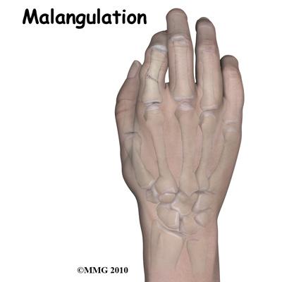 Complications Stiffness is probably the most common complication of finger fractures. Stiffness can occur quickly even in the uninjured fingers if they are placed in a cast or splint.
